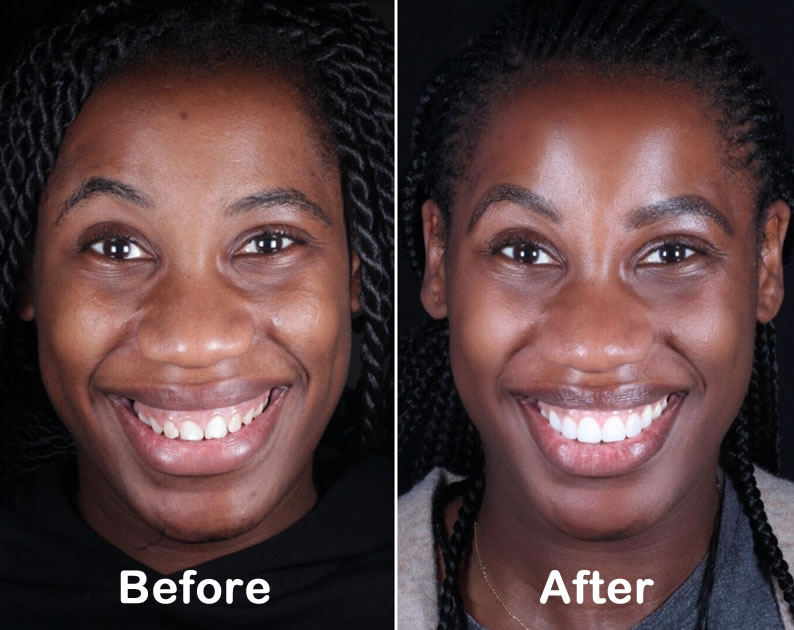 Cosmetic Dentistry Watford | Teeth Whitening | Dental Veneers Bushey