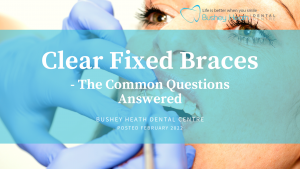 Clear Fixed Braces - The Common Questions Answered